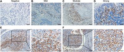 PD-1H Expression Associated With CD68 Macrophage Marker Confers an Immune-Activated Microenvironment and Favorable Overall Survival in Human Esophageal Squamous Cell Carcinoma